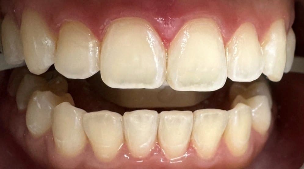 ICON white spot treatment — after treatment