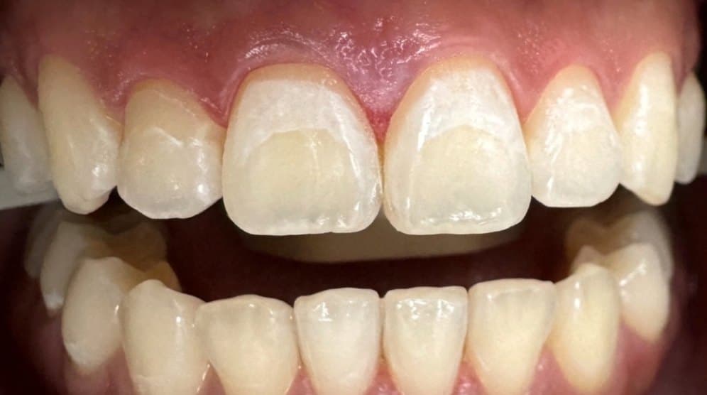 ICON white spot treatment — before treatment
