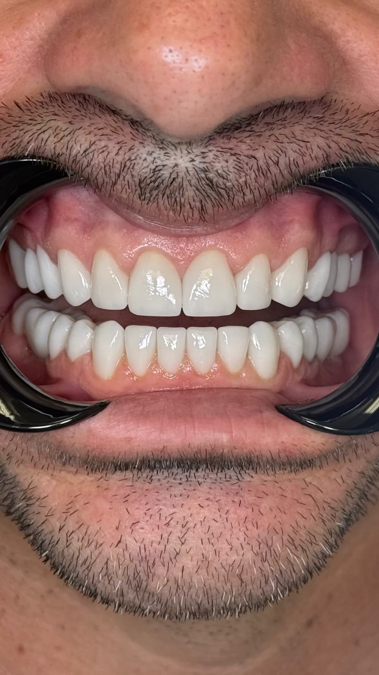 Intraoral view of a full arch of ceramic restorations