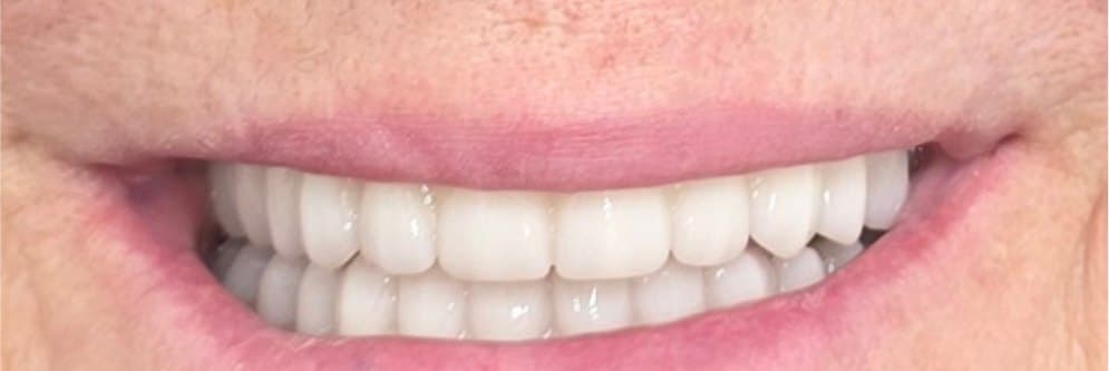 Full mouth reconstruction on dental implants — after treatment