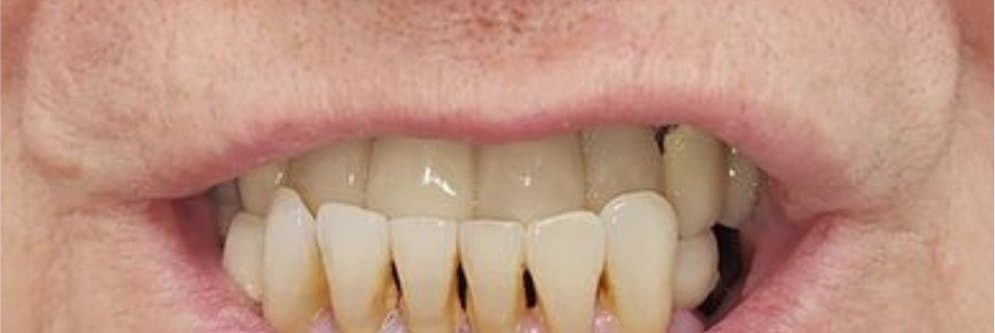 Full mouth reconstruction on dental implants — before treatment