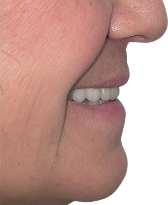 Full mouth reconstruction on dental implants — after treatment