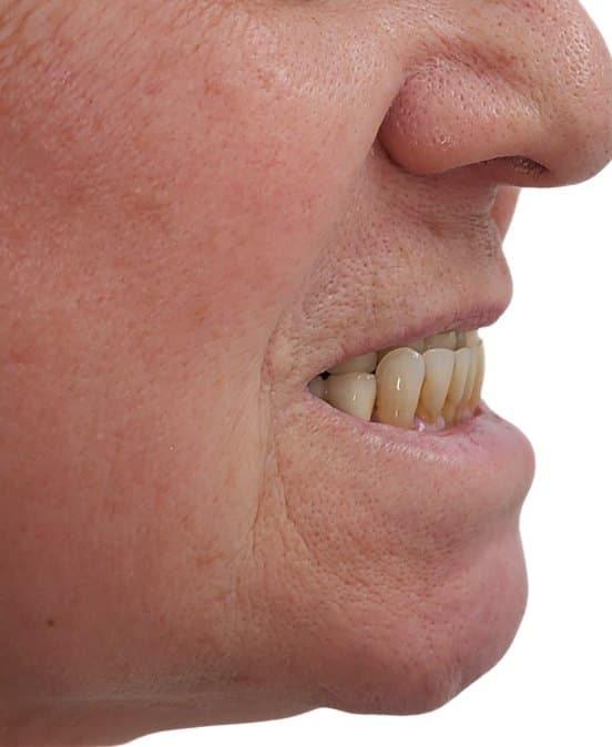 Full mouth reconstruction on dental implants — before treatment
