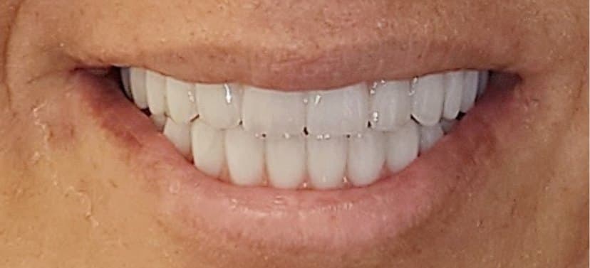 Full mouth reconstruction on dental implants — after treatment