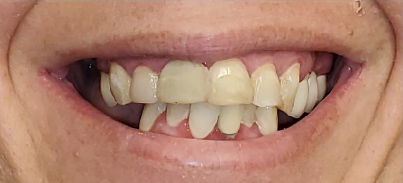 Full mouth reconstruction on dental implants — before treatment
