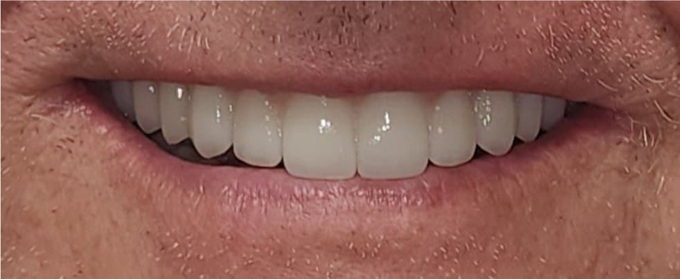 Full mouth reconstruction on dental implants — after treatment