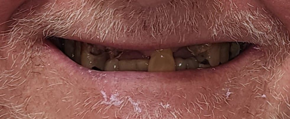 Full mouth reconstruction on dental implants — before treatment