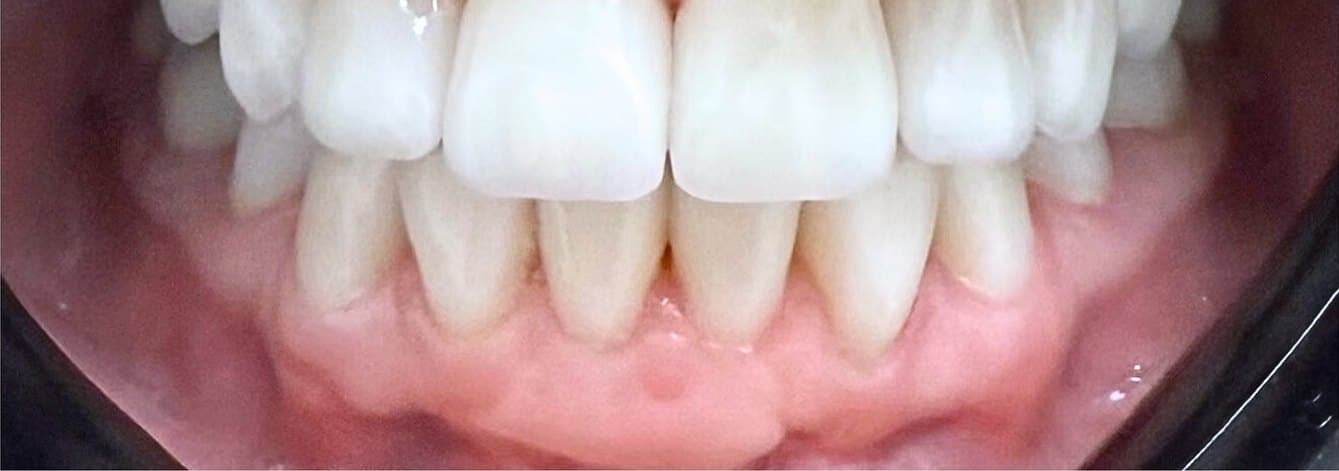 Full mouth rehabilitation with laser gum contouring — after treatment