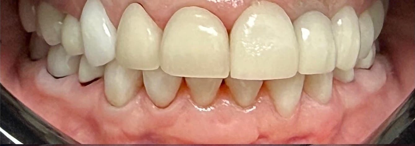 Full mouth rehabilitation with laser gum contouring — before treatment