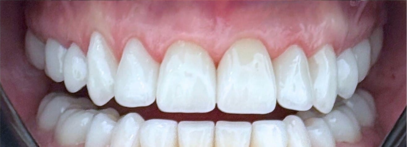 Full mouth rehabilitation with laser gum contouring — after treatment