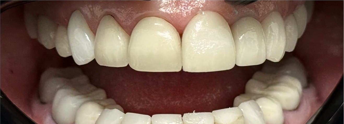 Full mouth rehabilitation with laser gum contouring — before treatment