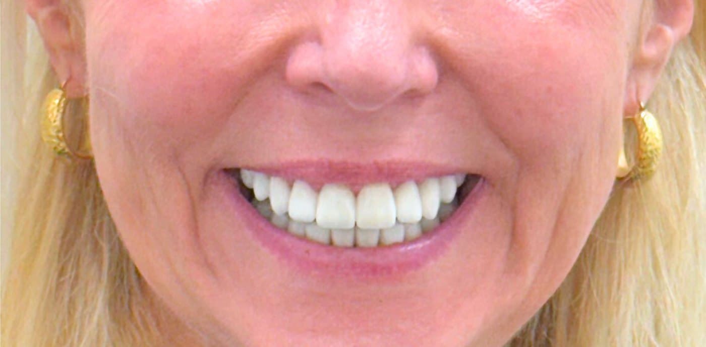 Full mouth rehabilitation with laser gum contouring — after treatment