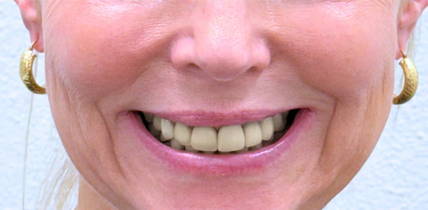 Full mouth rehabilitation with laser gum contouring — before treatment