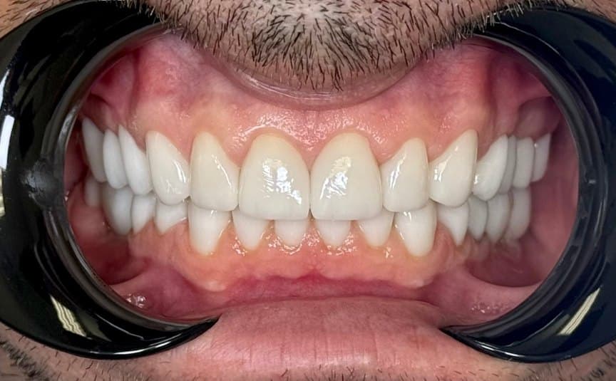 Full mouth rehabilitation — after treatment