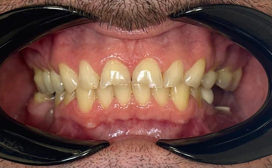 Full mouth rehabilitation — before treatment