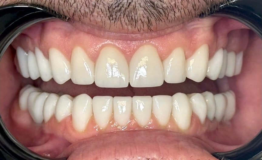 Full mouth rehabilitation — after treatment