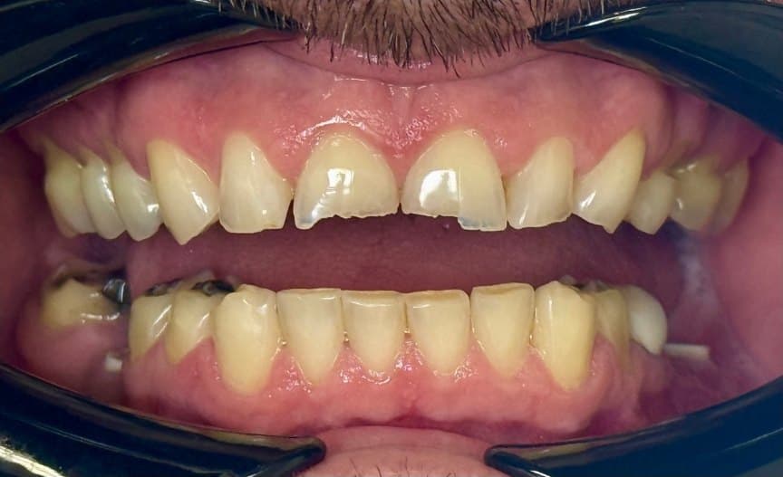 Full mouth rehabilitation — before treatment