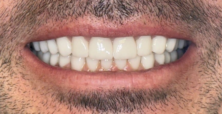Full mouth rehabilitation — after treatment