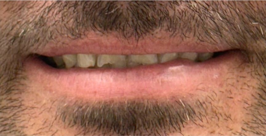 Full mouth rehabilitation — before treatment