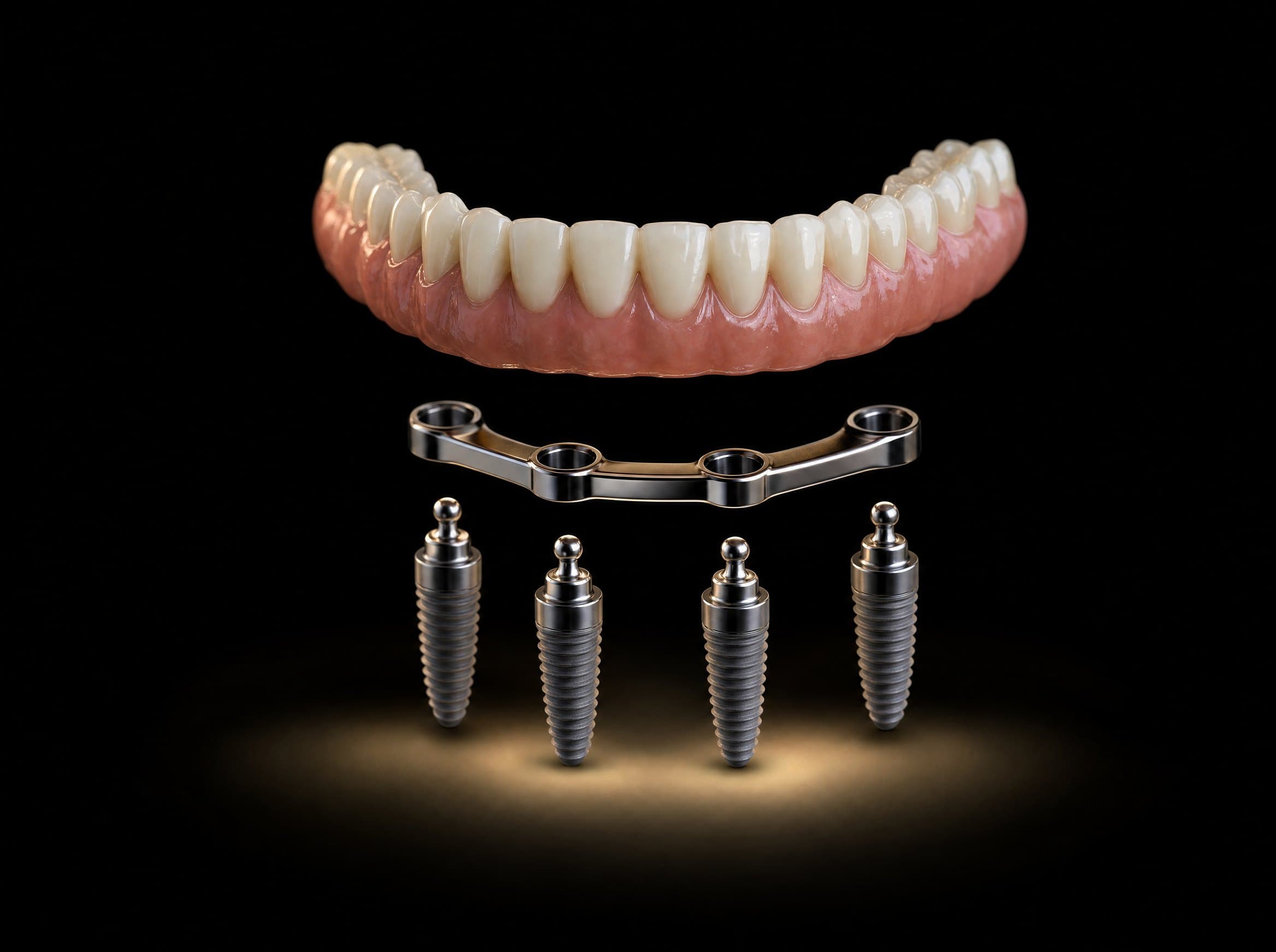 Locator or Bar Attachment Dentures