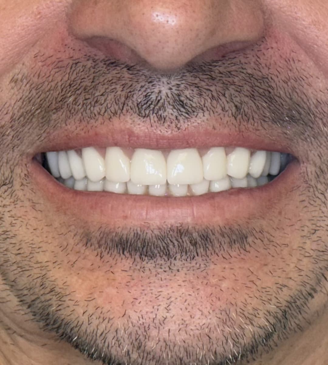 The same GLOW DNTL patient's smile after full mouth rehabilitation