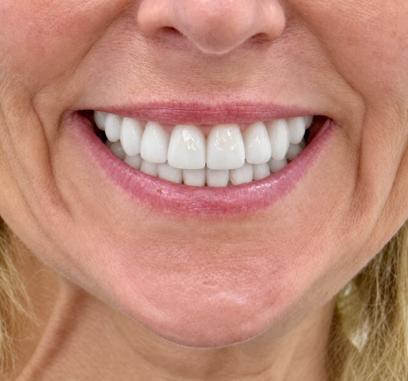 Smile Makeovers