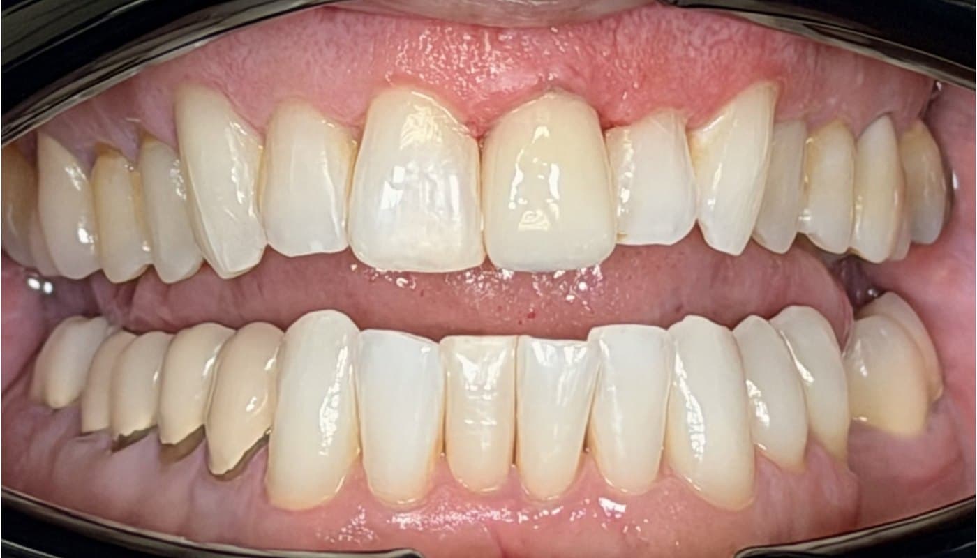 Single-visit ceramic crown — after treatment