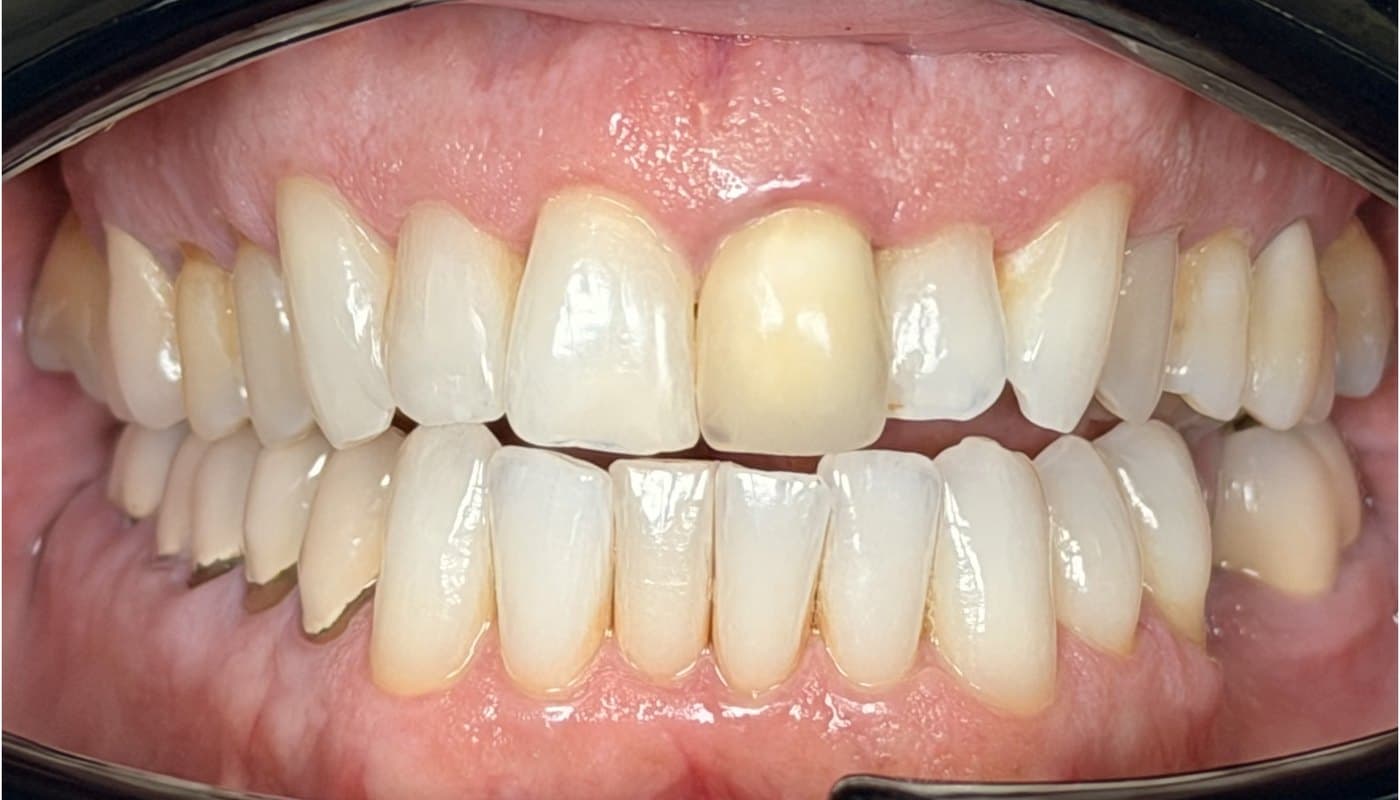 Single-visit ceramic crown — before treatment