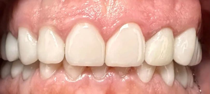 Single-visit ceramic crown — after treatment