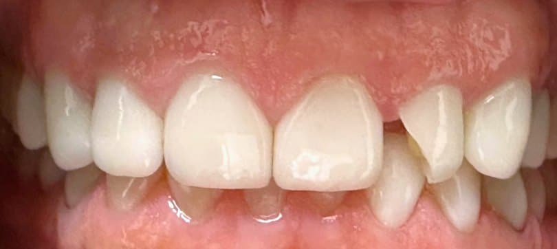 Single-visit ceramic crown — before treatment