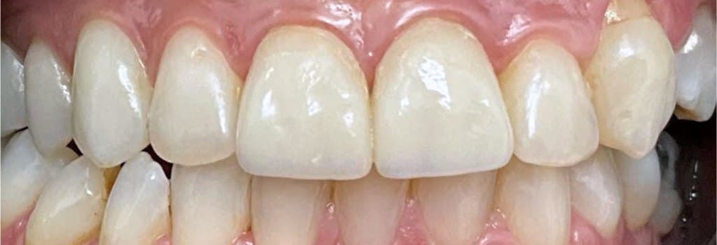 Single-visit ceramic crowns — after treatment