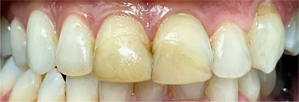 Single-visit ceramic crowns — before treatment