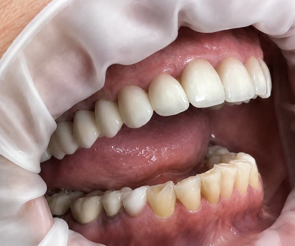 Single-visit implant placement and final crown — after treatment