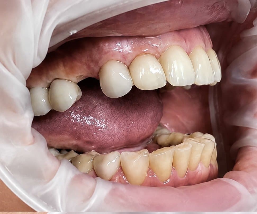 Single-visit implant placement and final crown — before treatment