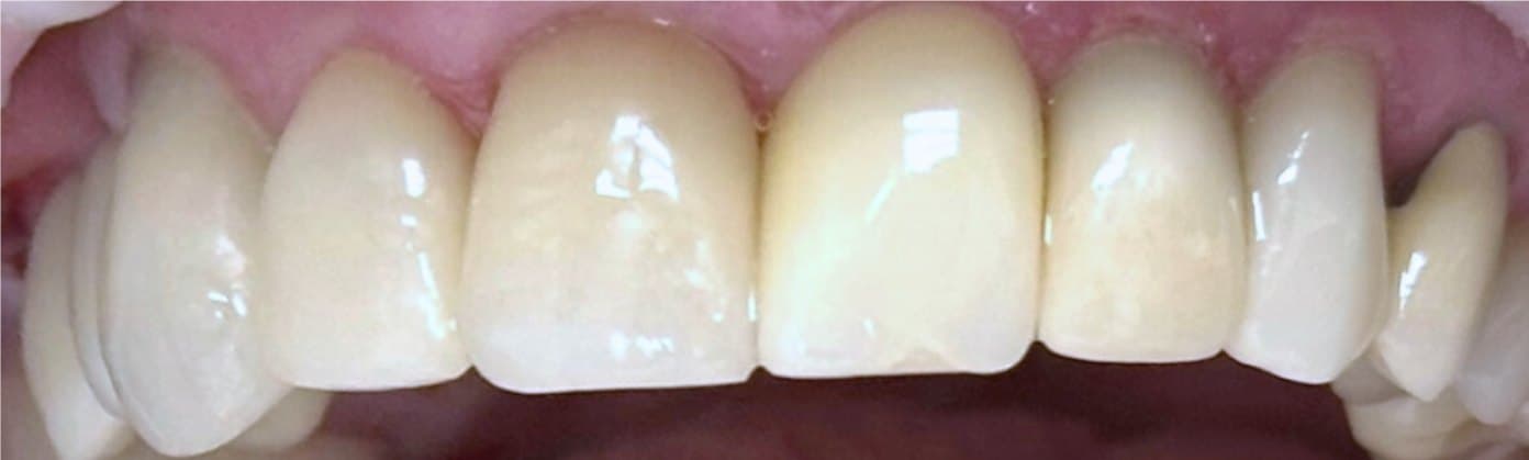 Single-visit immediate implant placement and final crown — after treatment