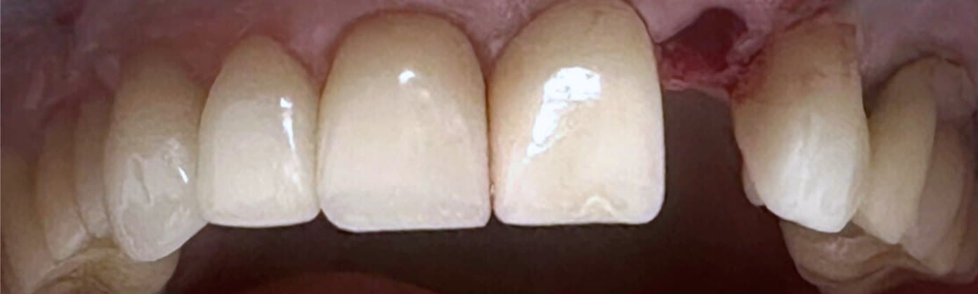 Single-visit immediate implant placement and final crown — before treatment