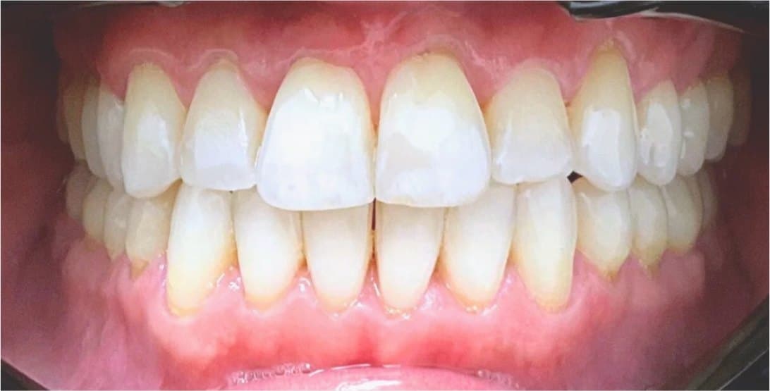SureSmile clear aligners — after treatment