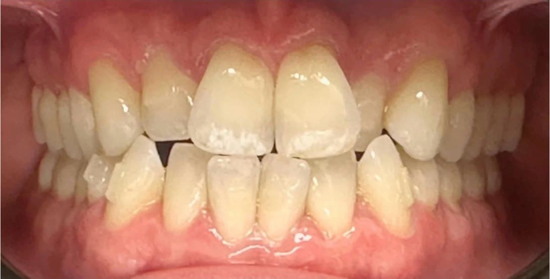 SureSmile clear aligners — before treatment