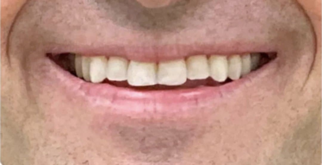 SureSmile clear aligners — after treatment