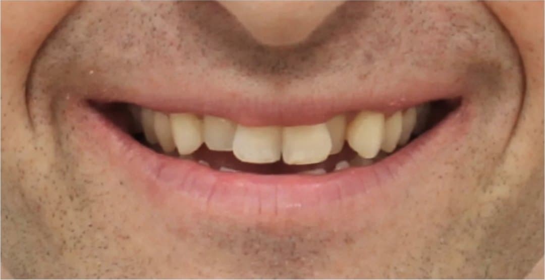 SureSmile clear aligners — before treatment