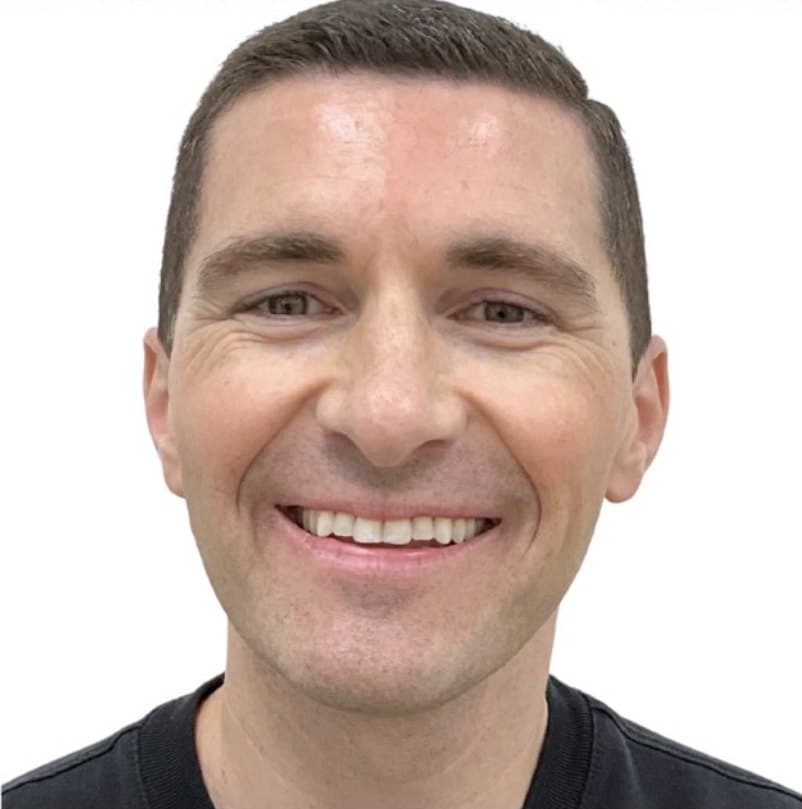 SureSmile clear aligners — after treatment