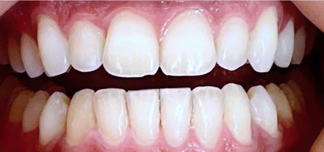 SureSmile clear aligners — after treatment