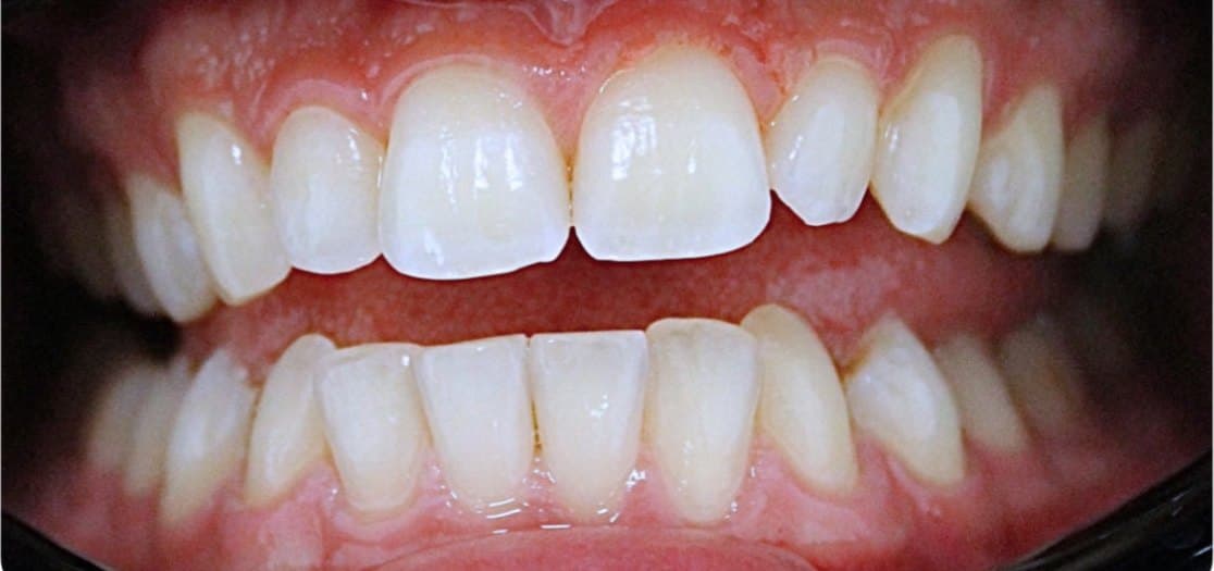 SureSmile clear aligners — before treatment