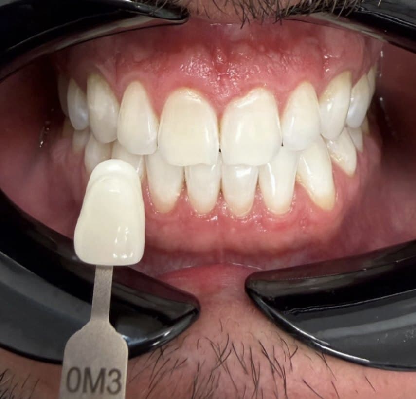 Zoom in-office whitening — after treatment