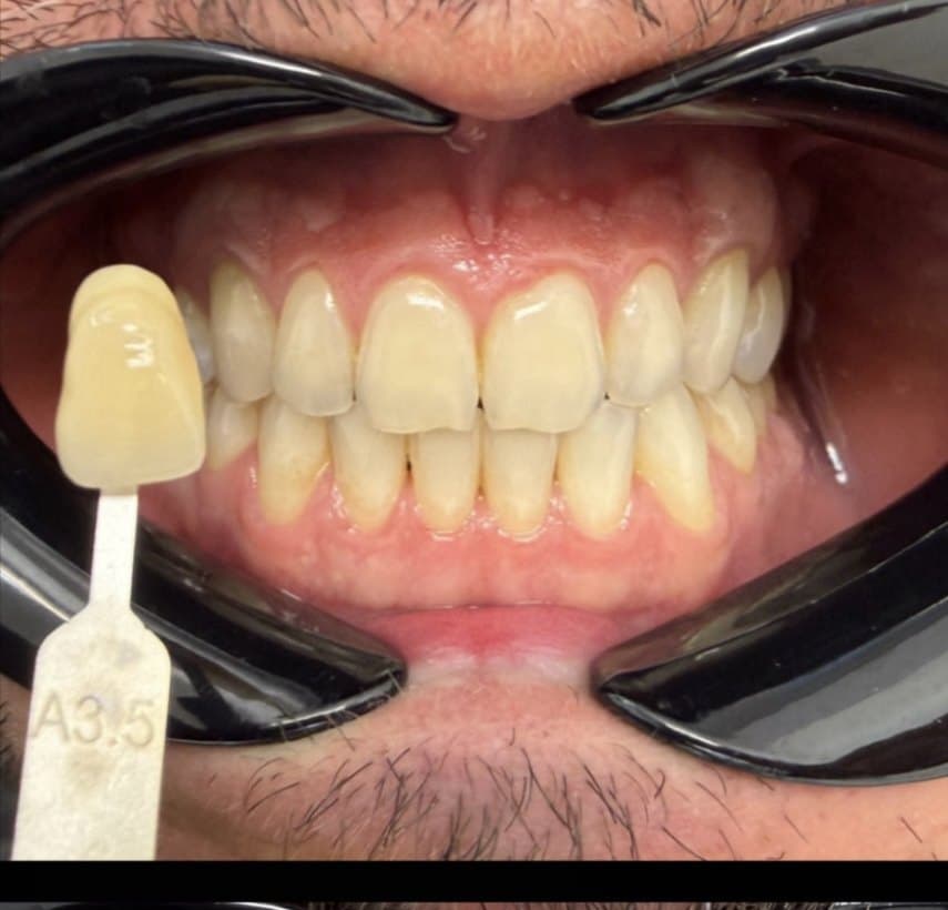 Zoom in-office whitening — before treatment