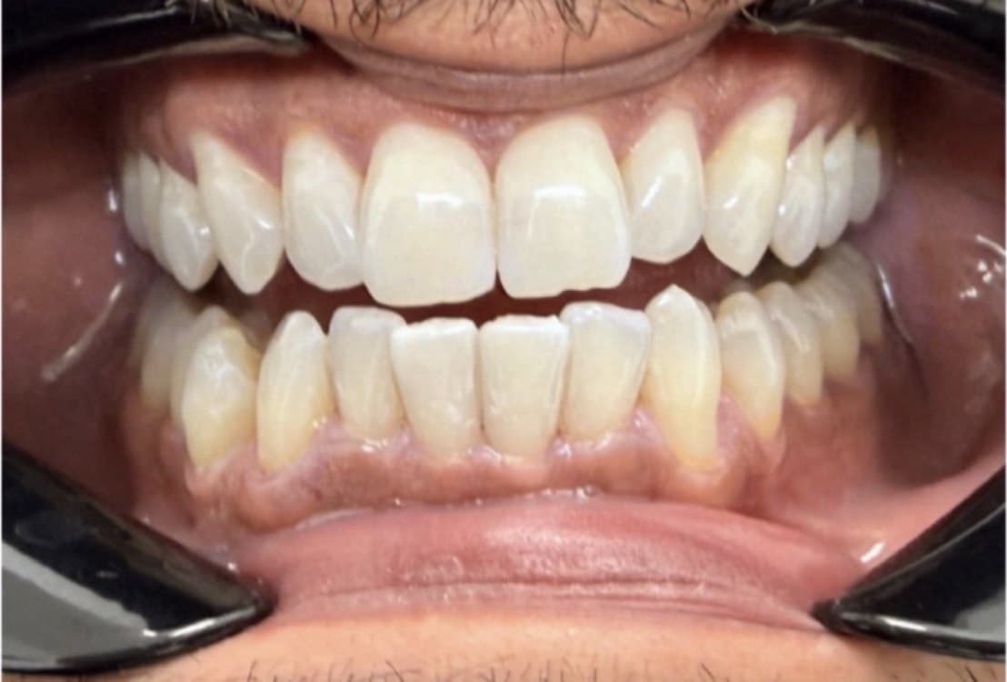 Zoom in-office whitening — after treatment