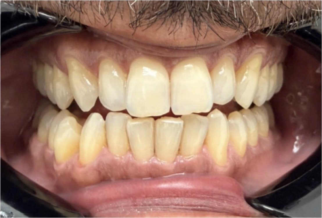 Zoom in-office whitening — before treatment
