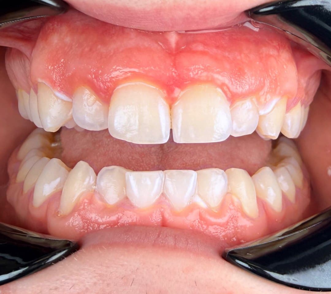 Zoom in-office whitening — after treatment