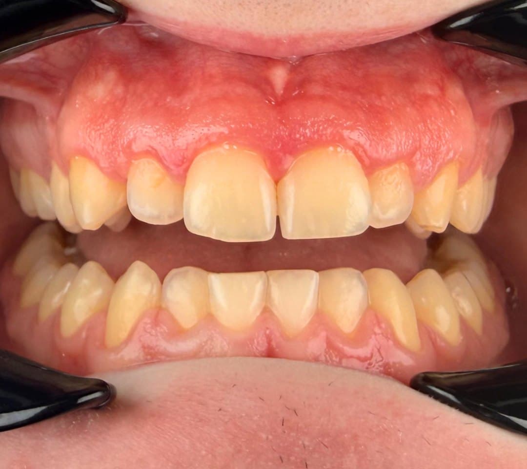 Zoom in-office whitening — before treatment